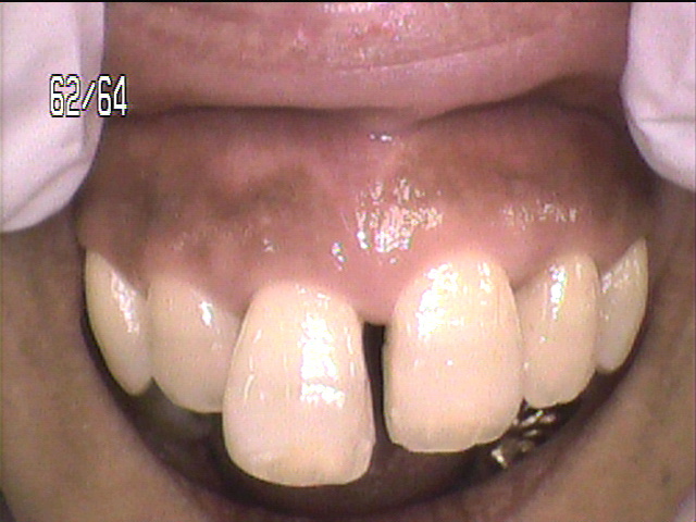 歯周病治療前　10_1
