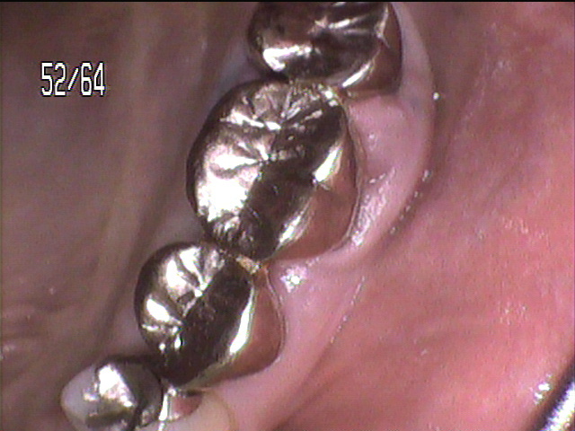 歯周病治療前　6_1